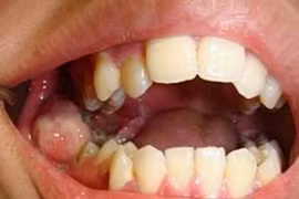 Sau nhổ răng khôn, thanh niên 18 tuổi ung thư đầy mồm gây sốc