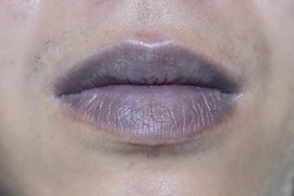 ​Dấu hiệu ở môi cảnh báo bạn mắc bệnh nguy hiểm 