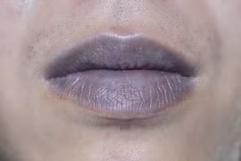 ​Dấu hiệu ở môi cảnh báo bạn mắc bệnh nguy hiểm 