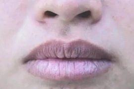 Phổi hư, cơ thể hiện rõ 3 dấu hiệu này 