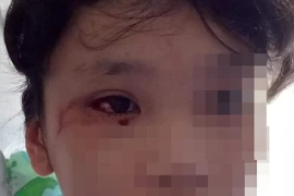 Học trực tuyến 8 tiếng/ngày, bé gái 12 tuổi chảy máu mắt ồ ạt 