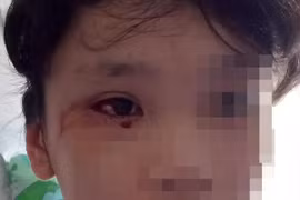 Học trực tuyến 8 tiếng/ngày, bé gái 12 tuổi chảy máu mắt ồ ạt 