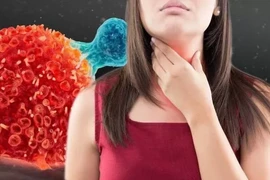 Dấu hiệu ung thư thực quản dễ nhầm với bệnh khác 