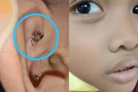 Bé trai đau tai, kiểm tra phát hiện “quái vật” ghê rợn ký sinh