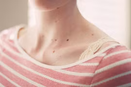 Những nốt ruồi dễ chuyển ác tính, nên cắt bỏ sớm