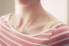 Những nốt ruồi dễ chuyển ác tính, nên cắt bỏ sớm