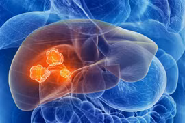 3 loại nguyên liệu làm tổn thương gan, nuôi tế bào ung thư