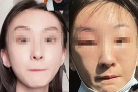 Tự nặn mụn cạnh lông mày, cô gái bị biến dạng khuôn mặt, nhiễm trùng