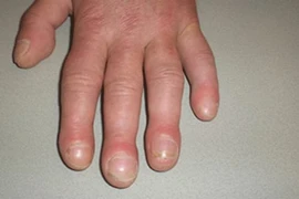 3 dấu hiệu xuất hiện ở bàn tay có nguy cơ bị bệnh phổi