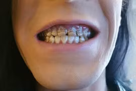 Chàng trai uống 6 chai nước tăng lực mỗi ngày và kết đắng