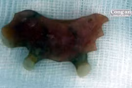 Răng giả “mọc” trong... thực quản