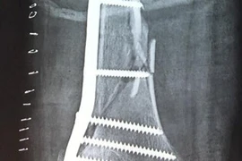 Cứu sống bệnh nhân gãy xương - tổn thương phức tạp động mạch đùi