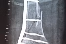 Cứu sống bệnh nhân gãy xương - tổn thương phức tạp động mạch đùi