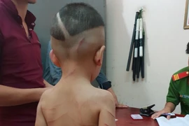 Phẫn nộ cha dượng bạo hành con riêng vợ bằng thắt lưng, móc áo