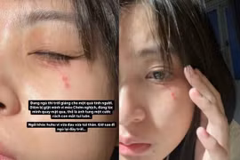 Nguyễn Lâm Thảo Tâm bị thú cưng "tấn công", gương mặt bị ảnh hưởng