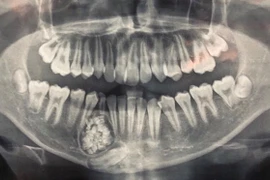 Thiếu niên phẫu thuật lấy ra gần 100 cái răng trong miệng