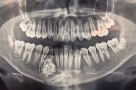 Thiếu niên phẫu thuật lấy ra gần 100 cái răng trong miệng