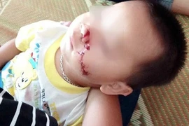 Thực hư việc bé trai 2 tuổi bị bố say rượu chém vào mặt