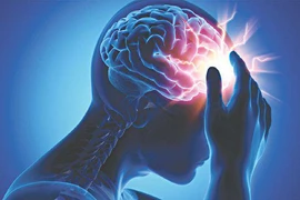 Đau đầu, mệt mỏi khi trời “ẩm ương”, coi chừng dấu hiệu đột quỵ