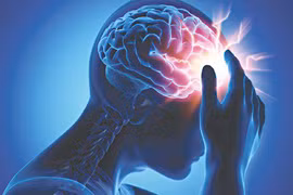 Đau đầu, mệt mỏi khi trời “ẩm ương”, coi chừng dấu hiệu đột quỵ