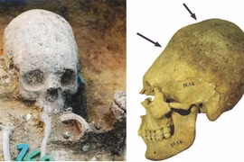 Sự thật chấn động 51 hộp sọ bị kéo dài ở Hungary