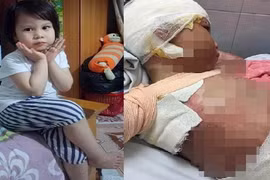 Cơ thể biến dạng của bé gái 5 tuổi bị bỏng cồn toàn thân