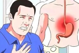 Bác sĩ khuyên 5 điều cực đơn giản giúp tránh xa bệnh trào ngược dạ dày