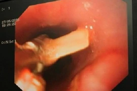 Hóc xương - không thể chủ quan 