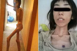 Thiếu nữ Nhật tố cáo từng bị ông nội bỏ đói, gầy như bộ xương khô