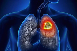Ngoài khói thuốc lá, còn loạt tác nhân hàng ngày cũng gây ung thư phổi