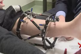 Tiết lộ điều chưa biết về phẫu thuật kéo dài chân