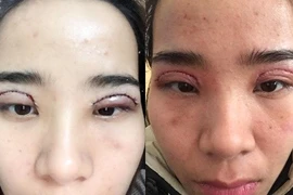 Biến chứng nguy hiểm khi cắt mí ở Spa không phép