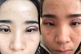 Biến chứng nguy hiểm khi cắt mí ở Spa không phép