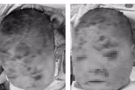 Nhiều trẻ tróc da, nhập viện sau tắm lá: Bác sĩ khuyến cáo gì?