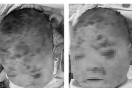 Nhiều trẻ tróc da, nhập viện sau tắm lá: Bác sĩ khuyến cáo gì?