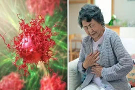 Ung thư di căn và những dấu hiệu phổ biến nhất 