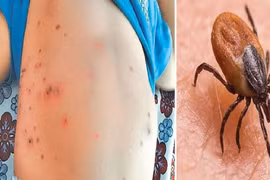 Sốt mò gây tử vong: Triệu chứng bệnh dễ nhầm lẫn