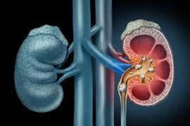 Triệu chứng bệnh sỏi thận dễ bị bỏ qua