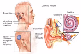 Loạt biến chứng nguy hiểm khi cấy ốc tai điện tử