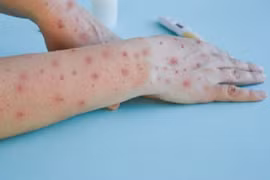 Lo ngại nguy cơ đồng nhiễm HIV và đậu mùa khỉ