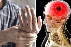 Dấu hiệu nhận biết sớm cơn đột quỵ nặng