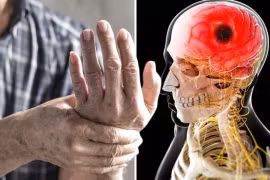 Dấu hiệu nhận biết sớm cơn đột quỵ nặng