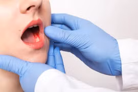 Nhiều người bỏ qua triệu chứng sớm ung thư lưỡi 