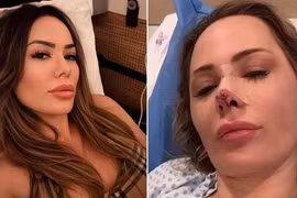 Kinh hãi người phụ nữ bị chó cắn mất một phần mũi