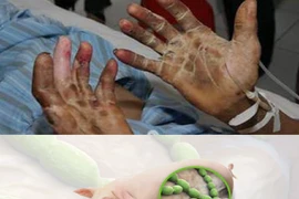 Bộ Y tế cảnh báo về căn bệnh nguy hiểm lây từ lợn sang người