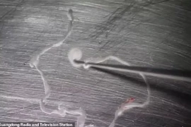 Nghiện ăn ốc, bị sán dây “ăn” não 15 năm