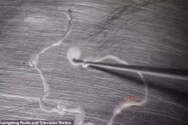 Nghiện ăn ốc, bị sán dây “ăn” não 15 năm