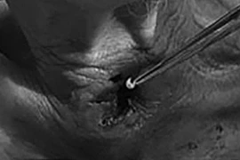 Kinh dị cảnh gắp hơn 30 con giòi làm tổ trong khí quản bệnh nhân