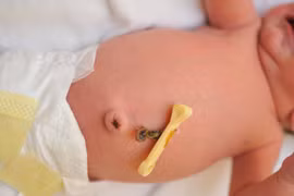 Thấy dấu hiệu này khi trẻ sơ sinh rụng rốn, mẹ đừng chủ quan