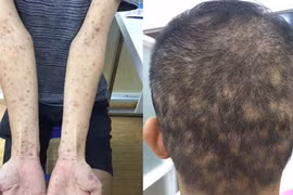 Bệnh giang mai tăng nhanh, có thể tổn thương tim, gan và tử vong